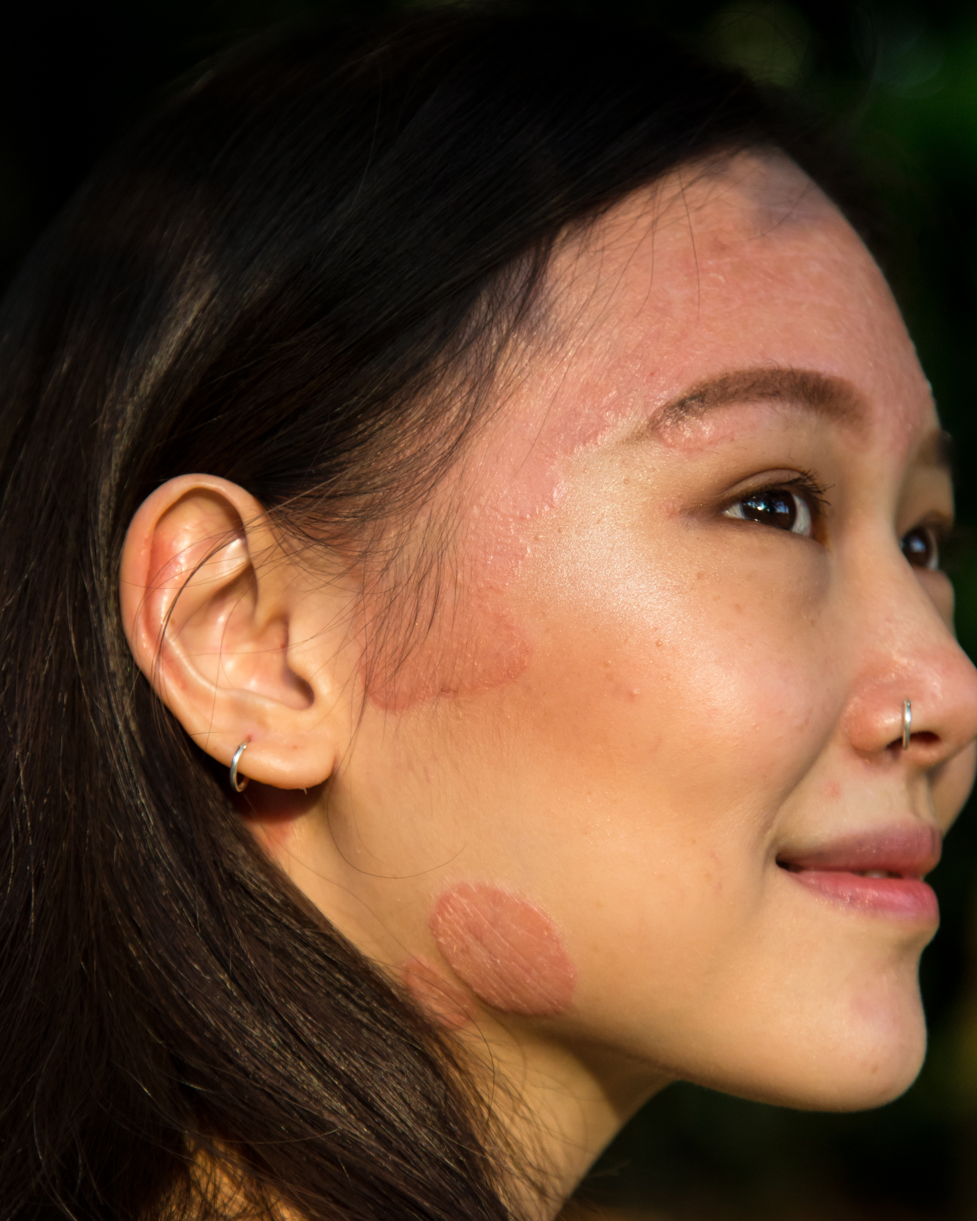 Rocyie Wong with psoriasis
