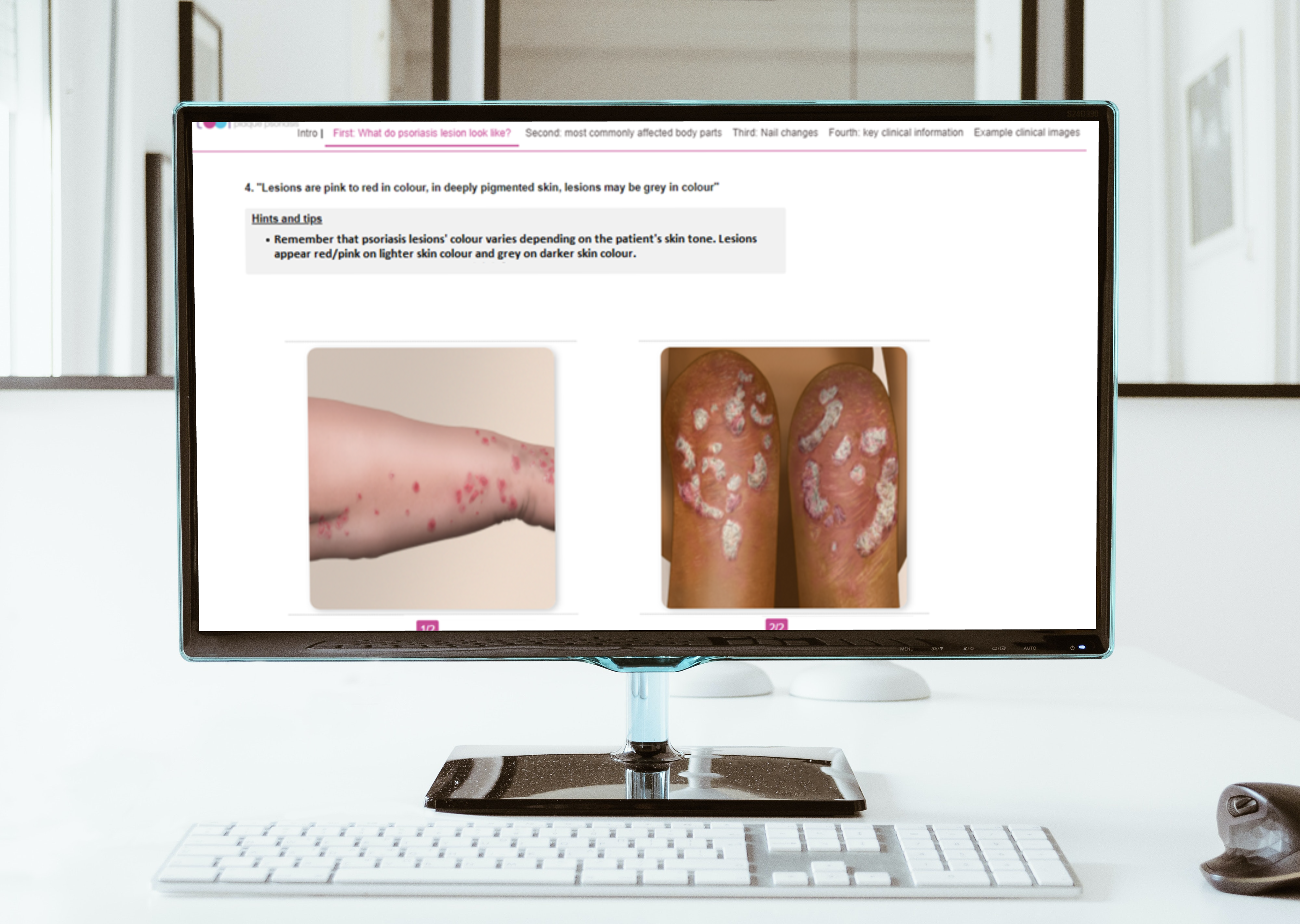 A computer screen shows the training tool comparing two images of psoriatic disease, one on a white arm, and the other on darker tone legs.